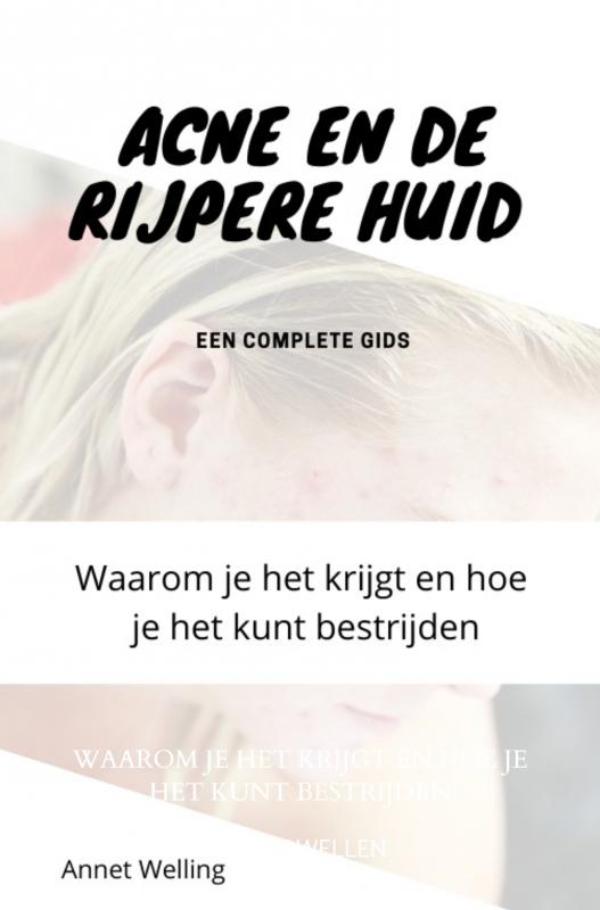 Acne bij volwassenen