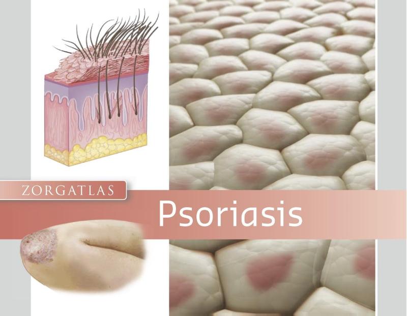 Psoriasis